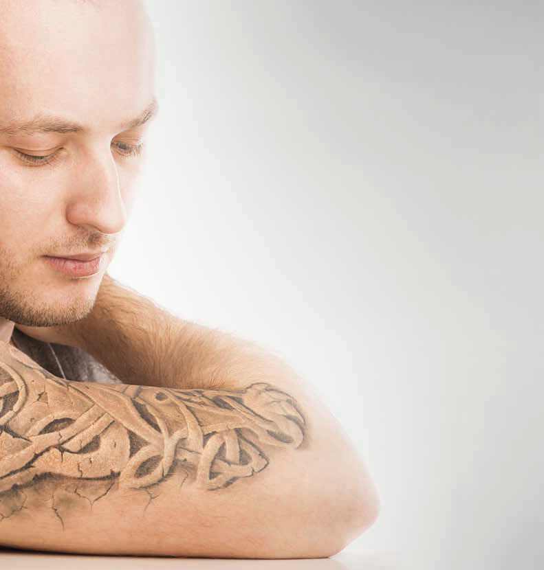 rimozione tatuaggi